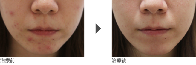  ■頬、顎(あご)周りのニキビ治療 20代後半 女性