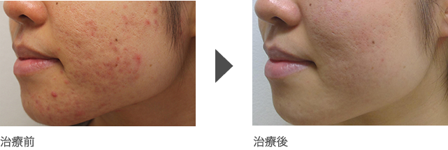  ■頬、顎(あご)周りのニキビ治療 20代後半 女性