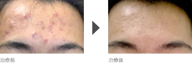 しこりニキビ治療 10代男性