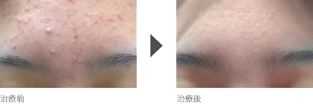 額の化膿ニキビ治療 10代女性