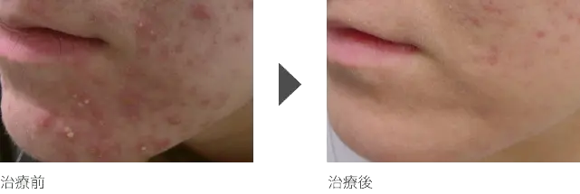 顎（あご）周りの化膿ニキビ治療 10代女性