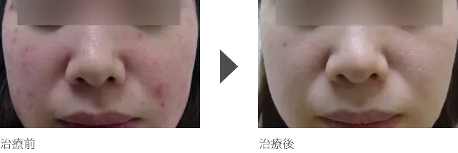 ニキビの赤み治療 20代女性