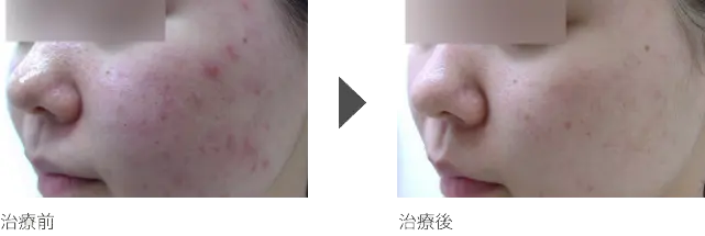 ニキビの赤み治療 20代女性