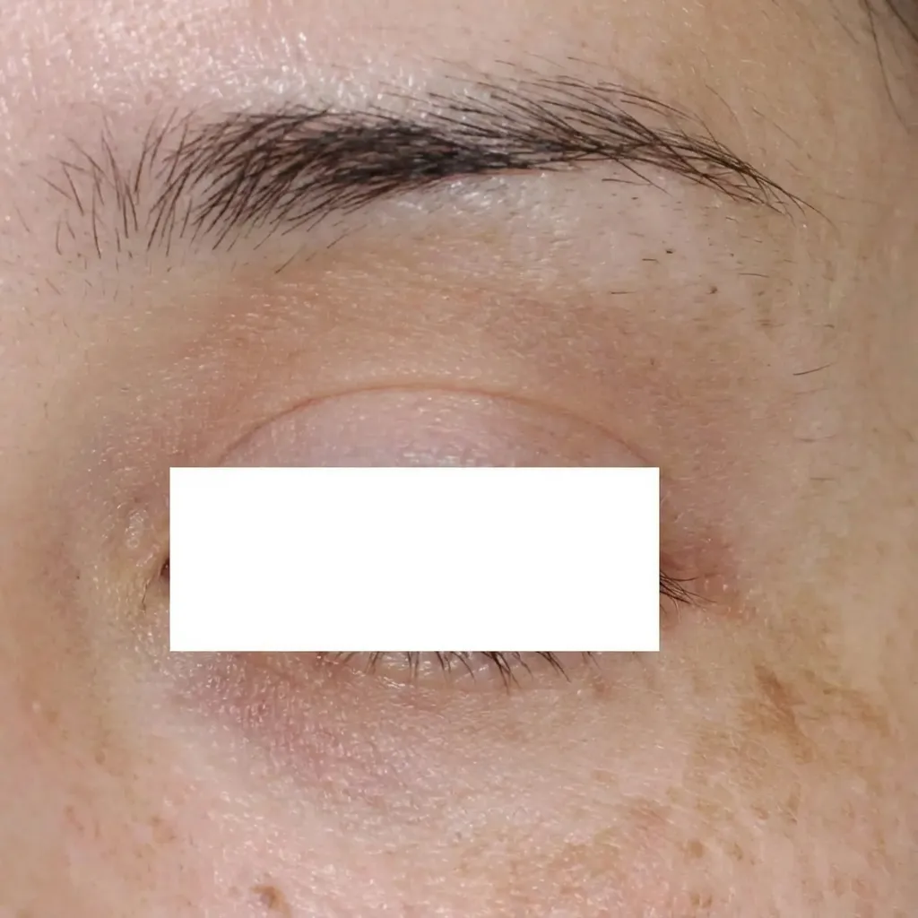 ADM（後天性真皮メラノサイトーシス）とは？