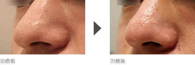 毛穴の黒ずみ除去 20代男性