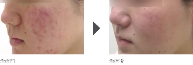 頬のニキビ治療 20代女性