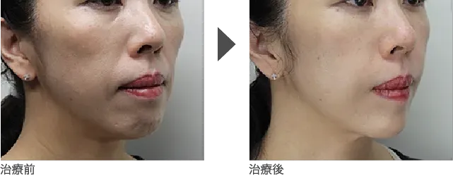 頬・頬こけのヒアルロン酸注入 40代女性