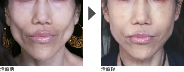 頬・頬こけのヒアルロン酸注入 50代女性