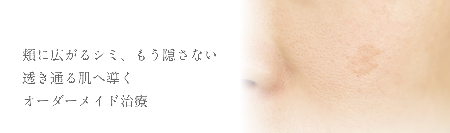 頬に広がるシミ、もう隠さない透き通る肌へ導くオーダーメイド治療