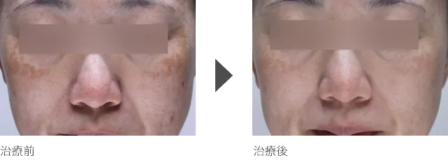シミ・くすみ治療 50代女性