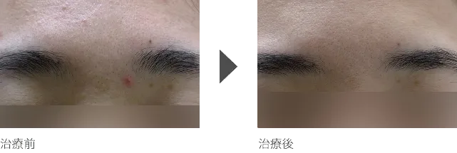 眉間のニキビ治療 20代女性