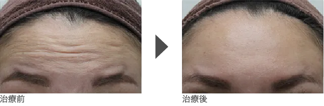 額のしわへの注入例 30代 女性