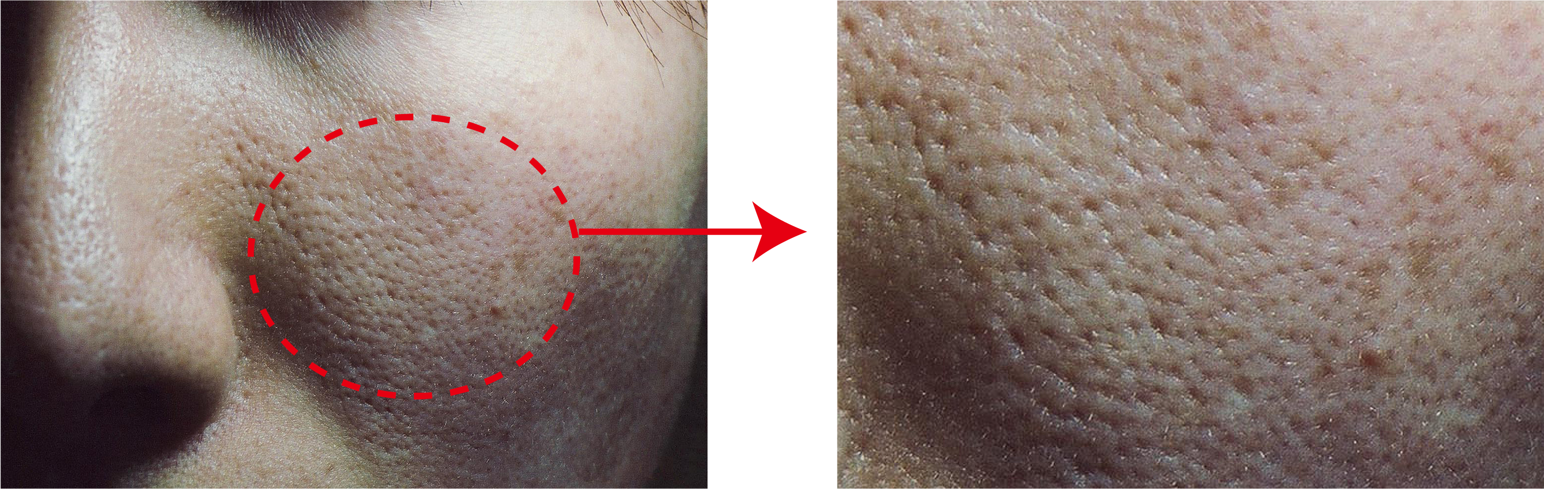 毛穴の開き（開き毛穴）