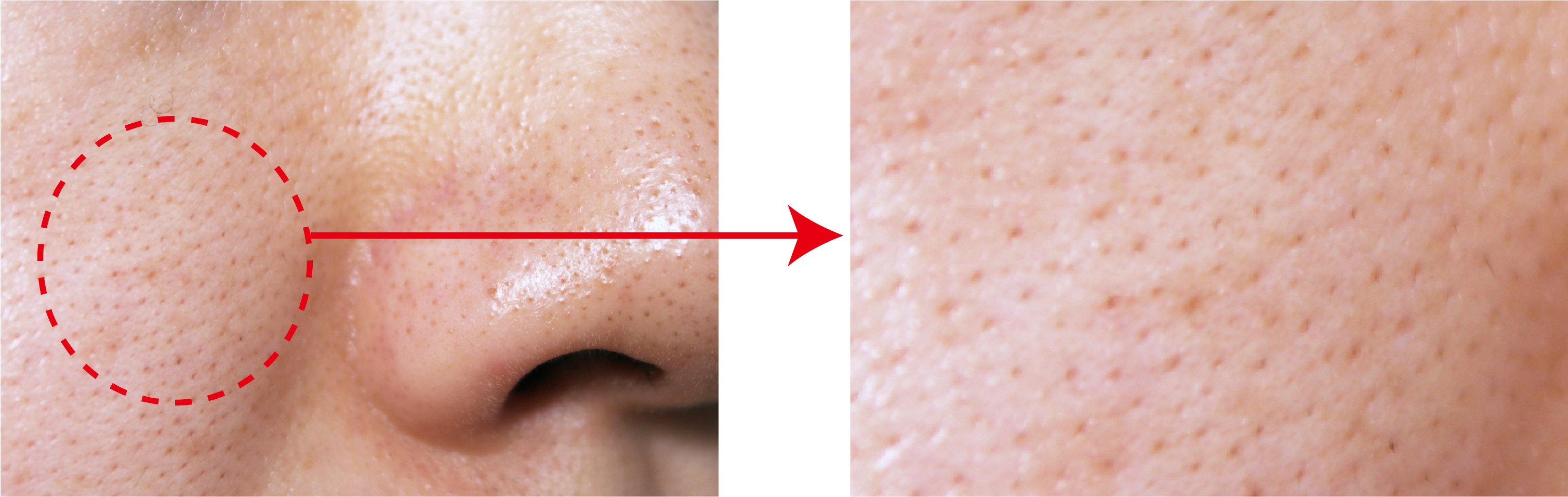 黒ずみ毛穴（産毛）