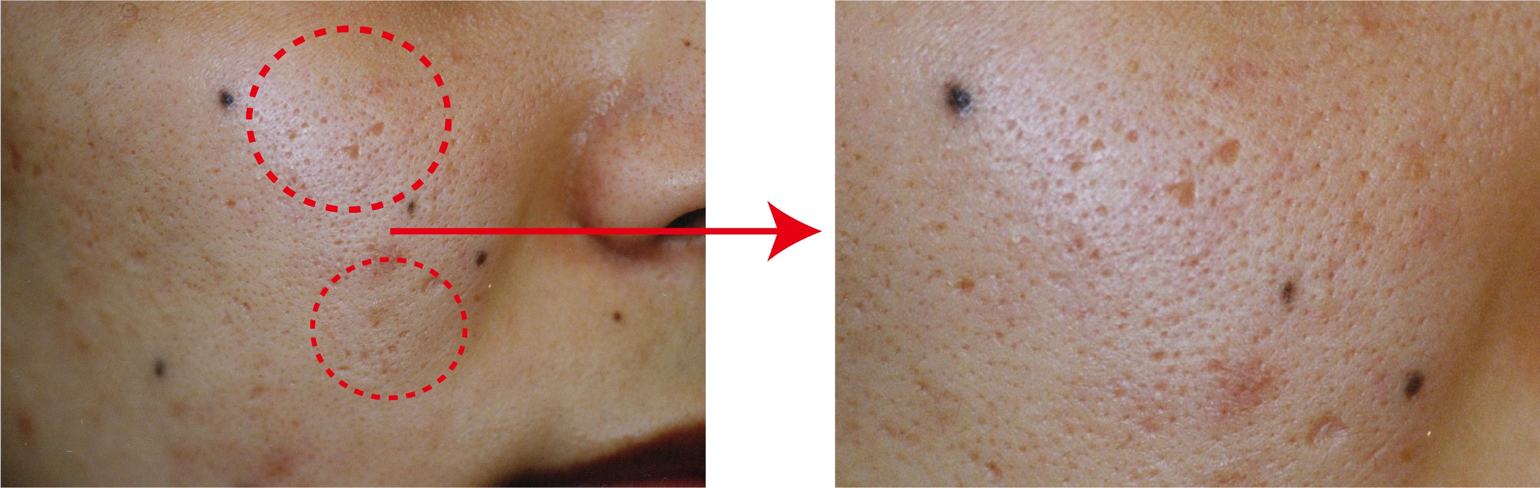 クレーター毛穴