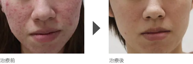 頬、顎（あご）周りの赤ニキビ治療 20代女性