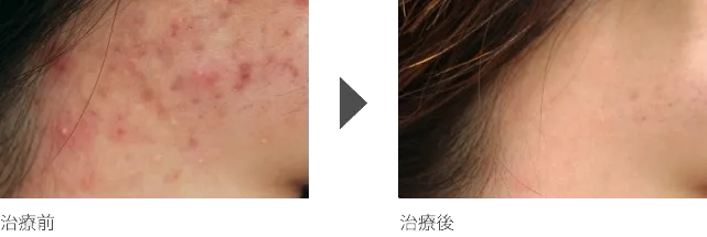 こめかみのニキビ治療 20代女性