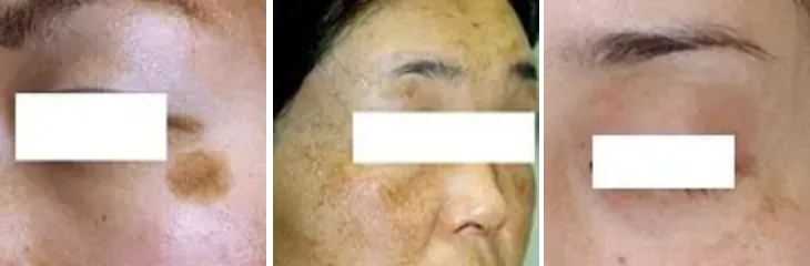 目の下、目元にできるシミとは？