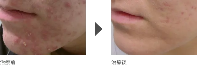 顎（あご）周りの黄ニキビ治療 10代女性