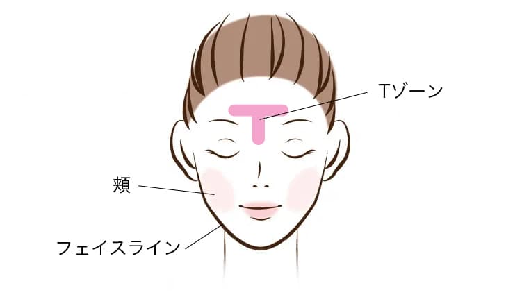 黄ニキビが発生しやすい場所